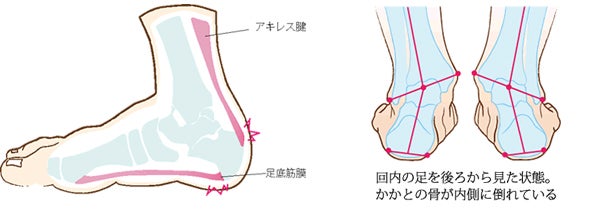 ランニング ウォーキングの足の痛み 今度こそ解消 シティリビングweb