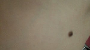 皮膚科 ほくろが大きくなり病気を疑って病院へ行った結果 シティリビングweb