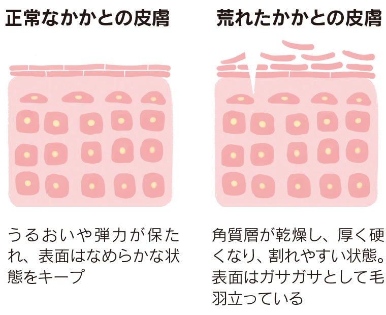 かかと荒れの原因は？ 早めのケアでひび割れ阻止を｜シティリビングweb